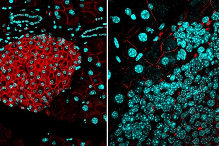 (Left) Normal expression of the protein activin B (red) in a healthy pancreas, which forms a barrier to cancer. (Right) Tumors can overcome that barrier by playing down the ALK7 pathway (cell nuclei are marked in cyan)