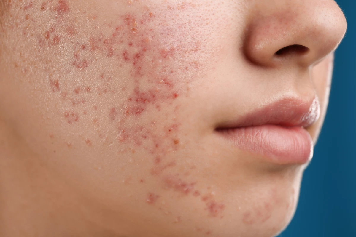 Existing acne treatments aren't effective for some people, and may produce unwanted side effects