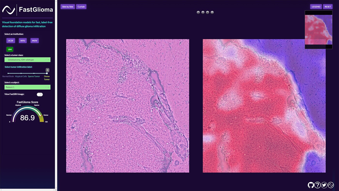 The team behind FastGlioma has open sourced the model and developed an online demo as well