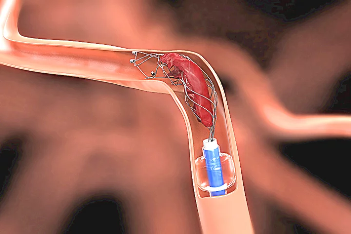 A cerebral blood clot being aspirated from the body after capture by the Solitaire (Image: Covidien)
