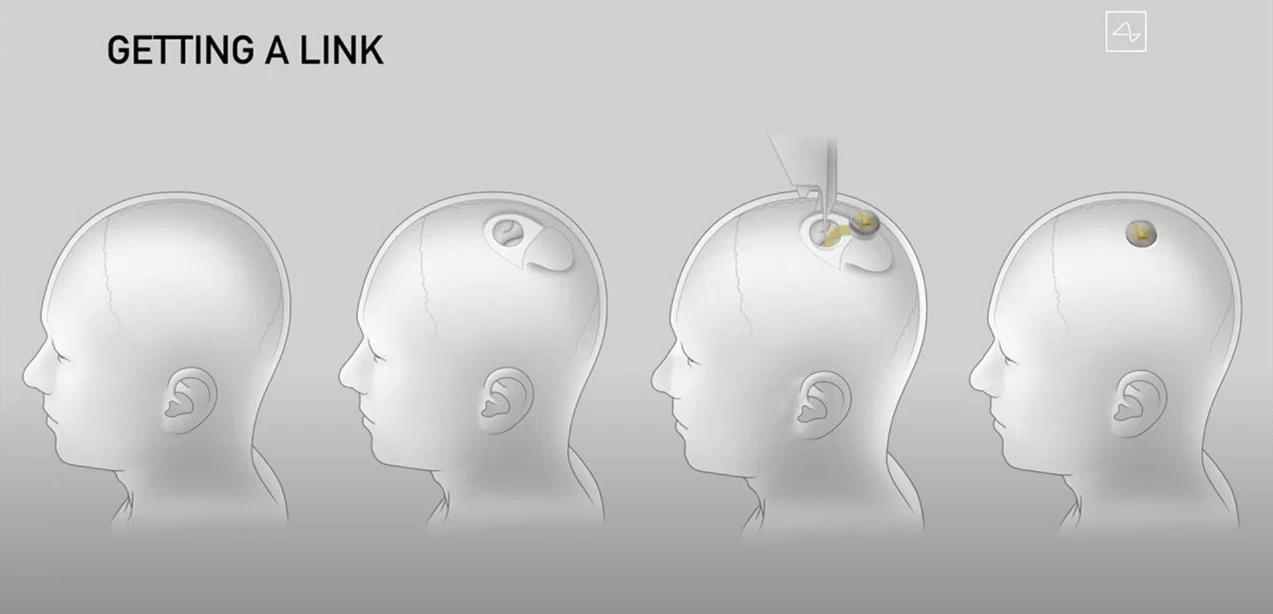 The Link device is designed to sit flush with the skull
