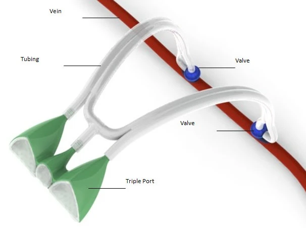 Students from Johns Hopkins University have created an implantable device, that could make dialysis treatments safer and easier (Photo: Johns Hopkins University)