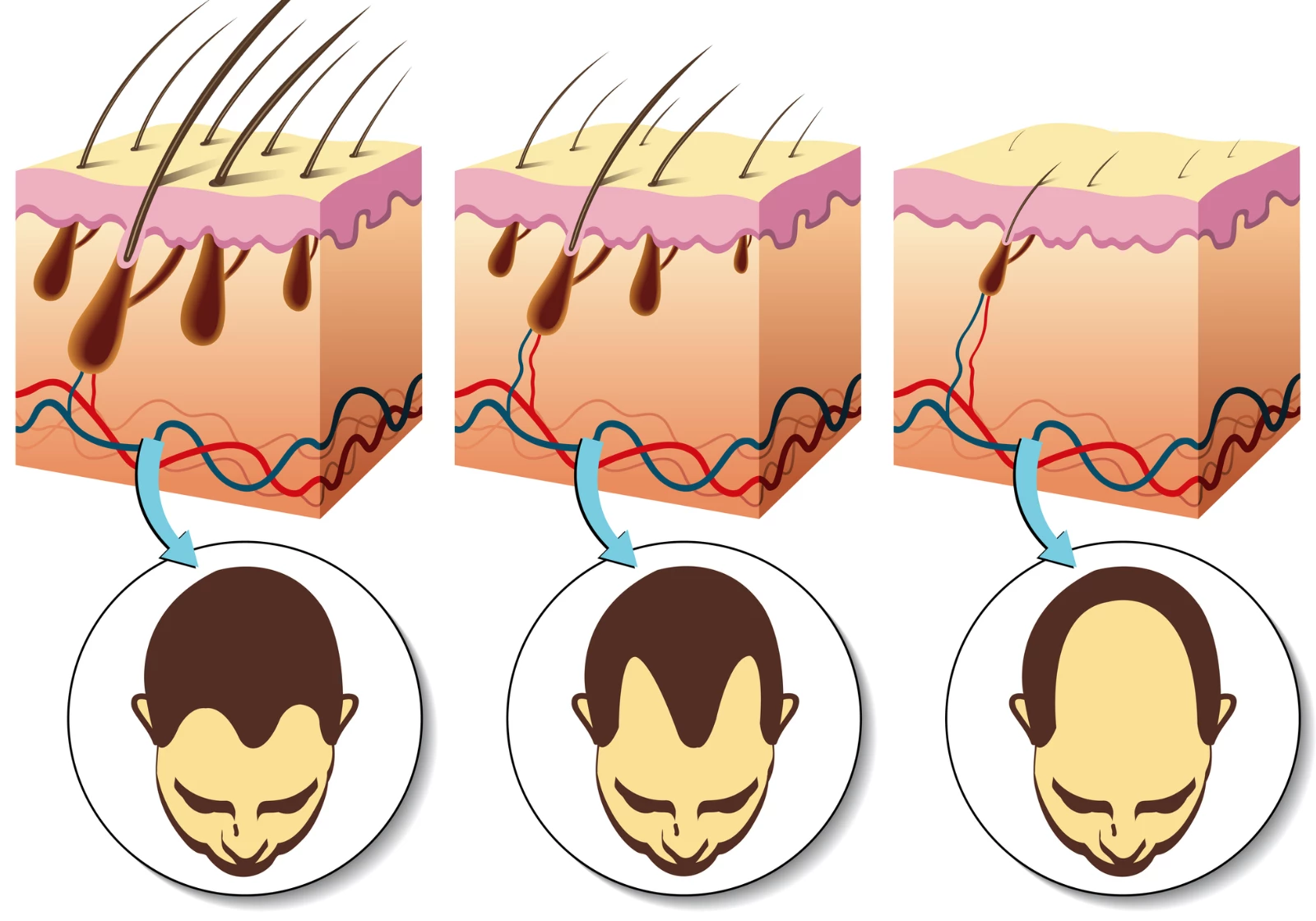 Scientists in China have developed a new microneedle patch that has shown promise in treating hair loss, by taking aim at poor circulation and oxidative stress