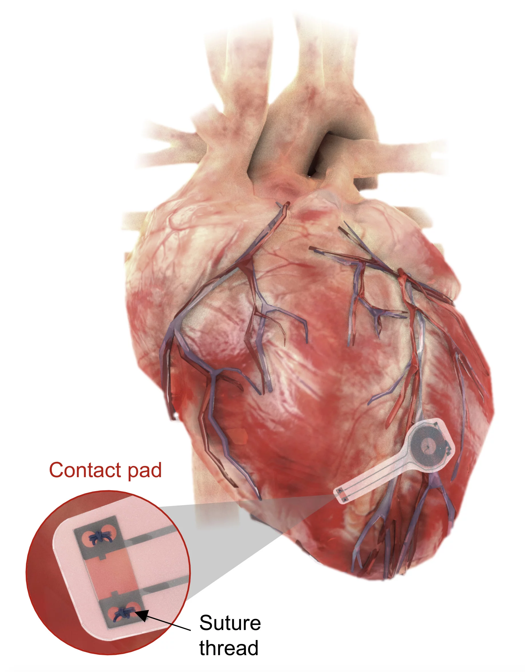 Illustration shows the world's first transient pacemaker on the surface of the heart
