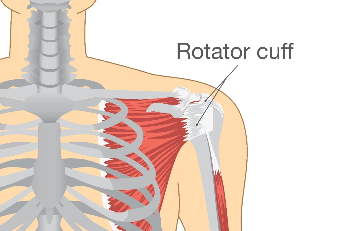 Torn rotator cuffs are a common injury, and are challenging to treat surgically