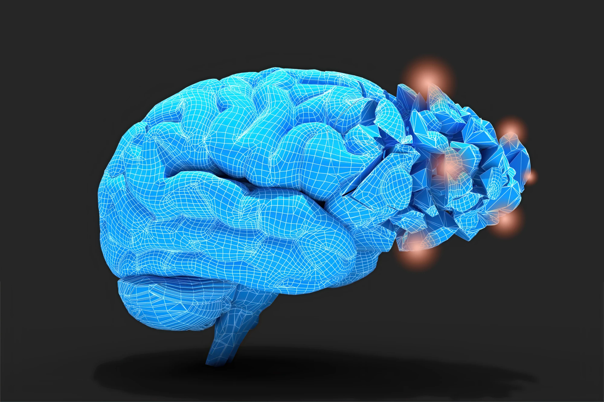 Two new studies only confirm associations between IBD and obesity and dementia, and do not provide evidence to suggest a direct causal link