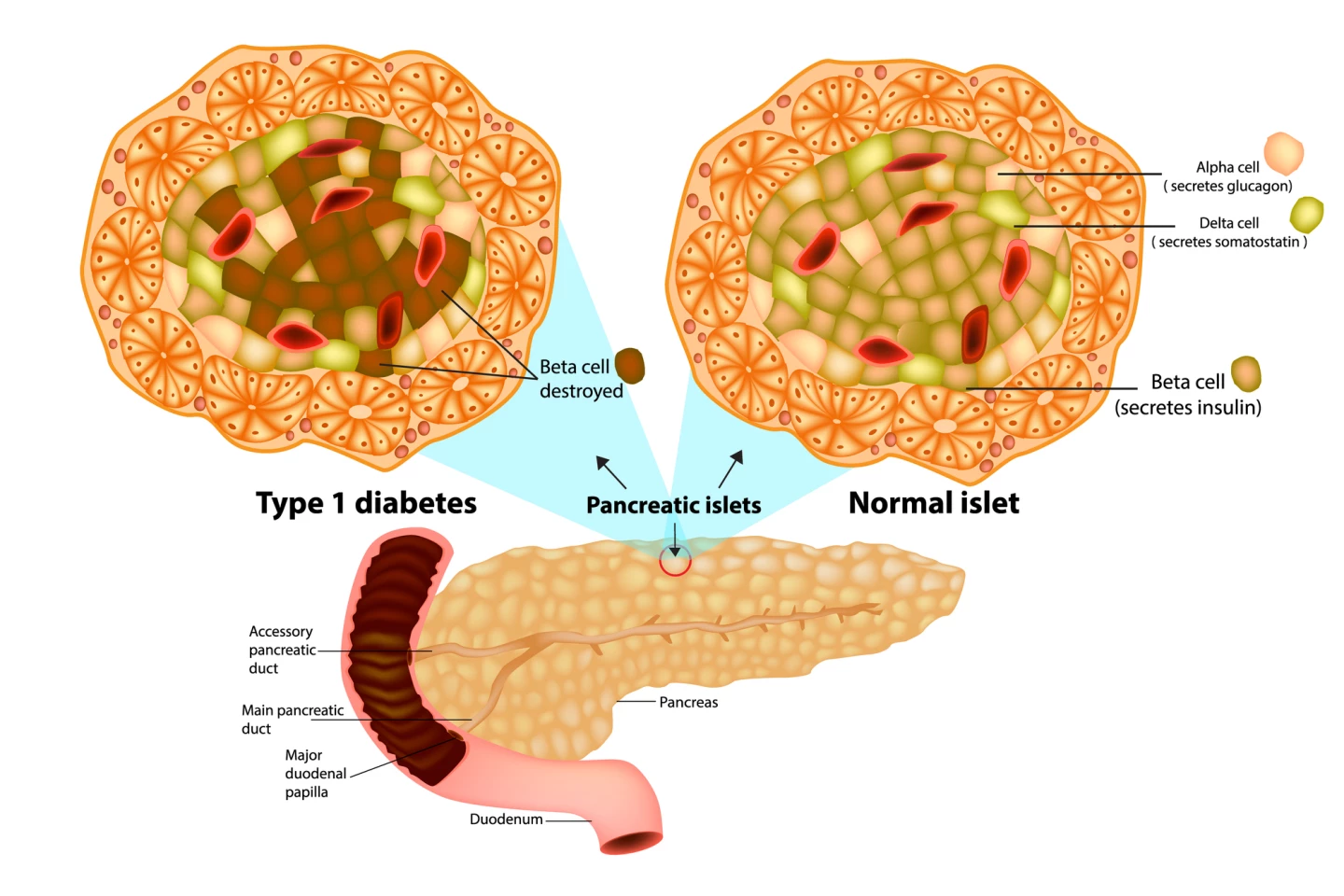 A diagram of what happens to the islet beta cells in type 1 diabetes (T1D)