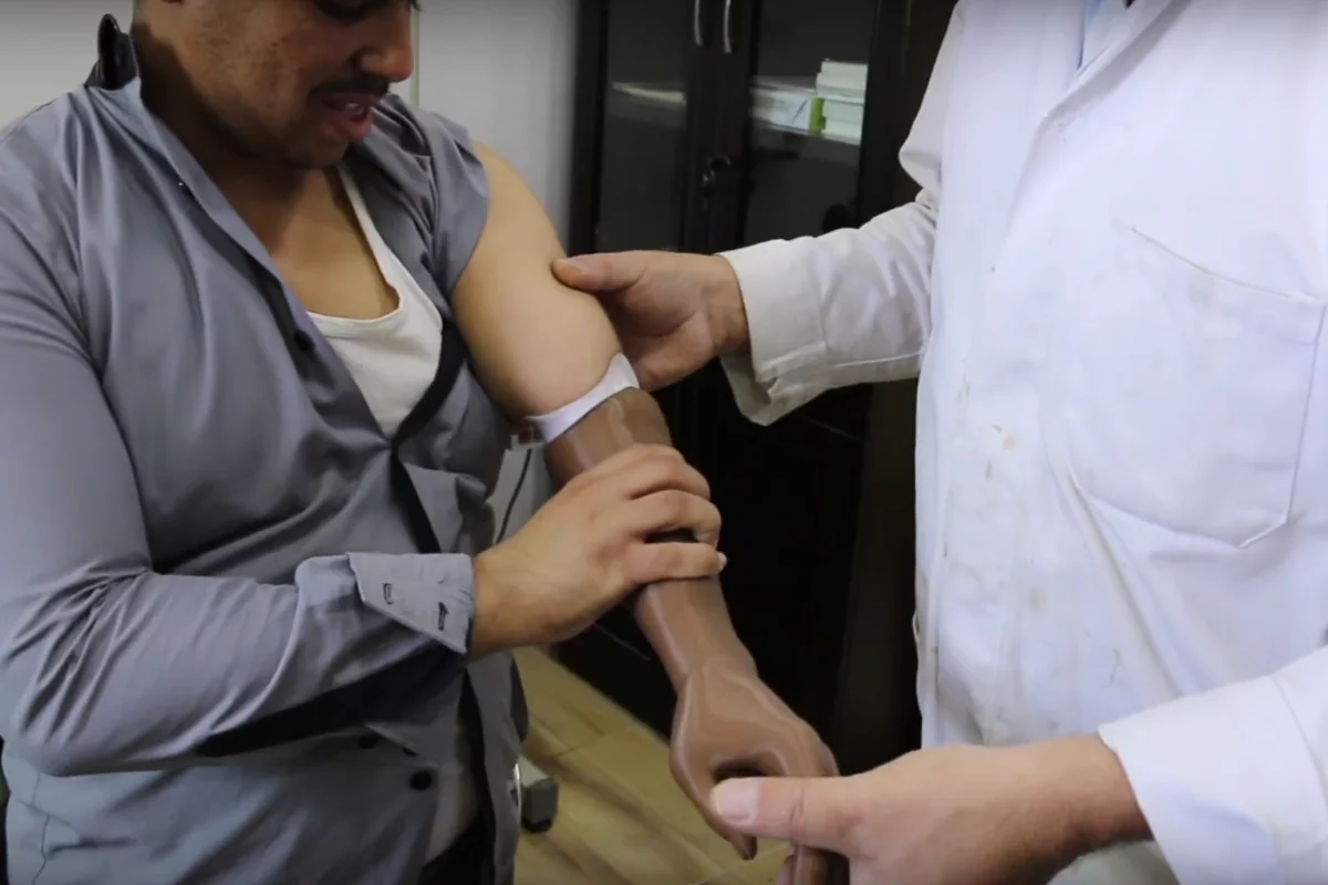 A printed prosthesis can cost around US$20, "rather than the hundreds of dollars a normal upper limb prosthesis would cost"