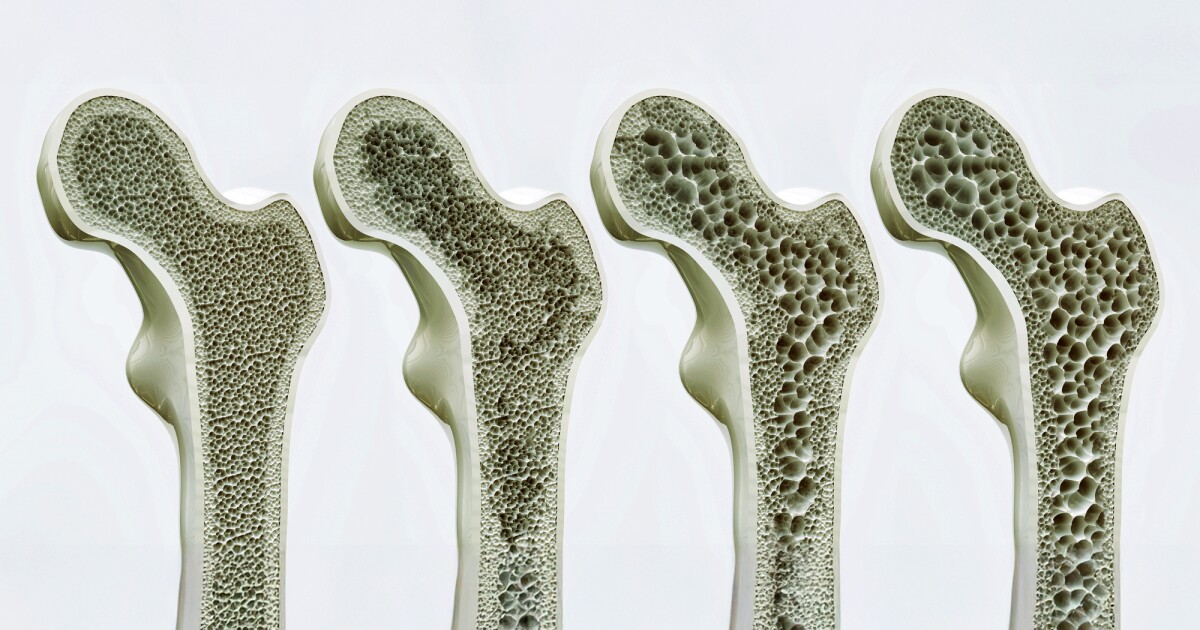 New receptor switch may revolutionize osteoporosis treatment New receptor switch may revolutionize osteoporosis treatment