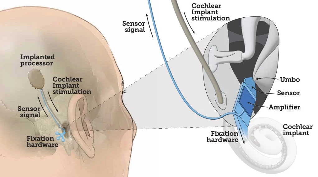This diagram shows how the UmboMic (blue) would be incorporated into the ear