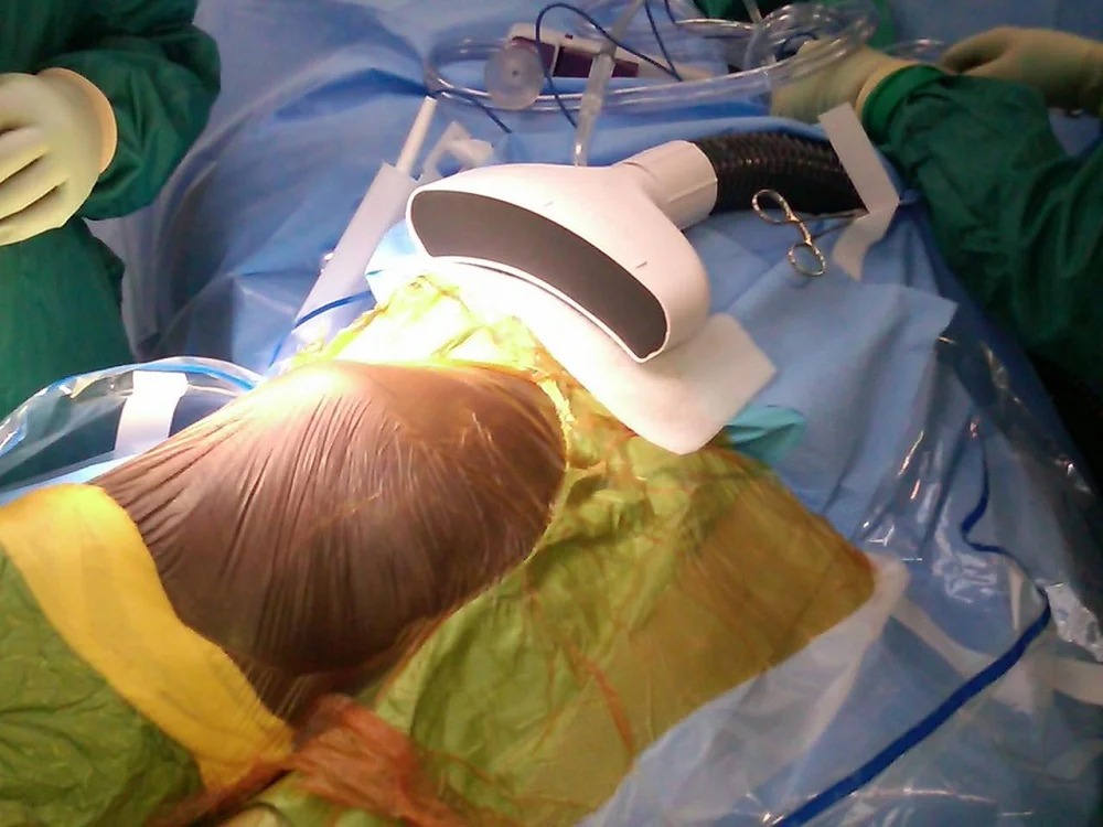 The Air Barrier System (ABS) which aims to reduce infection by providing a cocoon of highly purified air around the incision site during surgery (Photo: Nimbic Systems, Inc.)