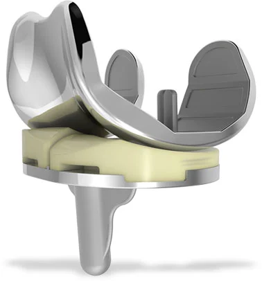 A CT scan is taken of the patient's hip, knee and ankle, with specialized software converting the scan into an exact 3D model of the patient's deteriorating knee