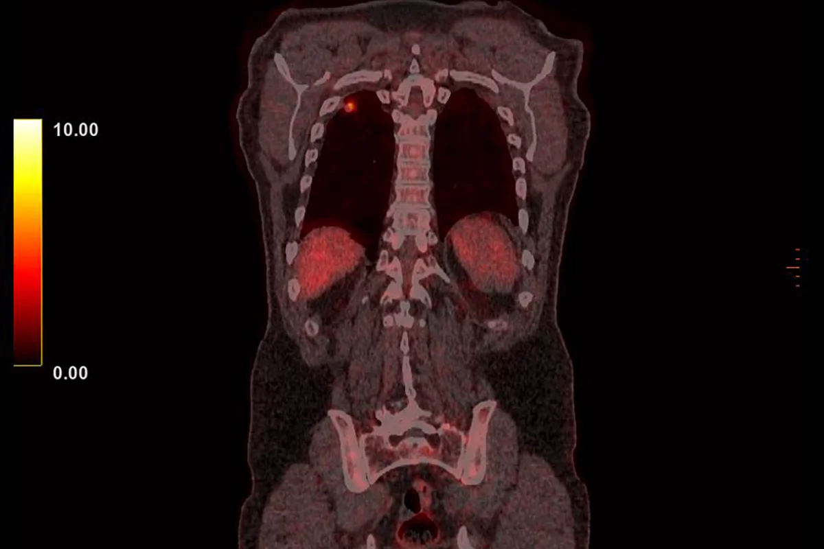 Immunotherapy drug tarlatamab has produced promising results in people with deadly small cell lung cancer for whom previous treatment hasn't worked