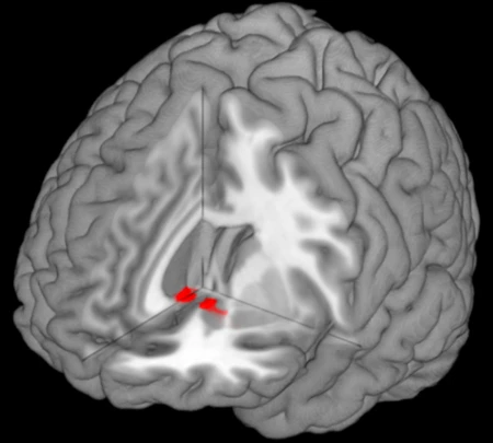Close neurological ties between reward-processing and pain-processing regions in the brain may allow love to provide effective pain relief
