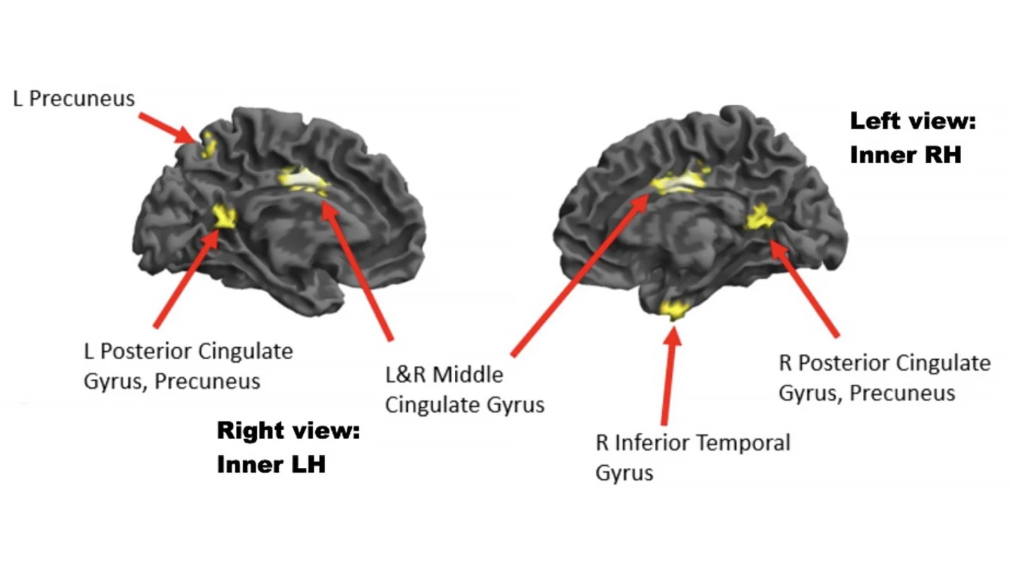 Inner views of the left and right sides of the brain showing areas of reduced brain activity when the high-experience musicians were in a high-flow state (compared to a low-flow state). These areas include key nodes of the brain’s default-mode network.