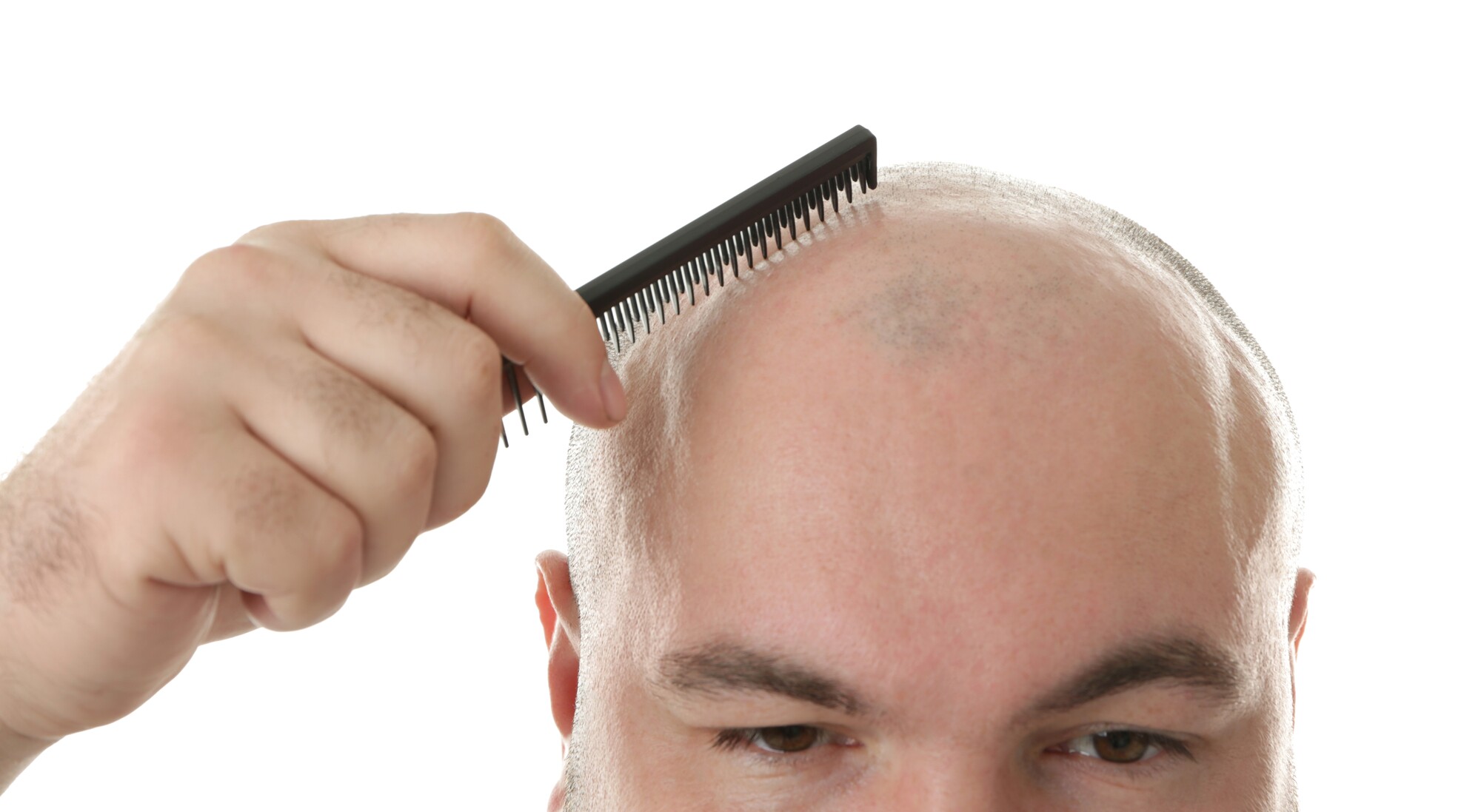 Hair-regrowth molecule could bypass stem cell treatments for baldness Hair-regrowth molecule could bypass stem cell treatments for baldness