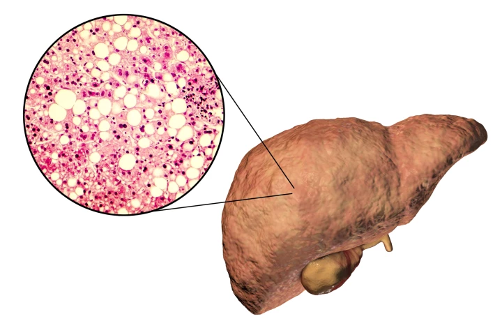 A model of a liver with fatty liver disease, along with a microscope image of how the tissue looks