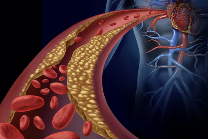 Triple-threat nanoparticles can identify artery build-up, break down the plaques and suppress inflammation
