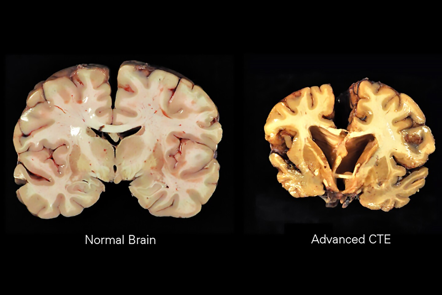 How a brain with advanced chronic traumatic encephalopathy (CTE) compares to a healthy brain