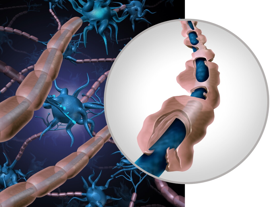 Criteria for MS have changed. Here’s what leading experts now outline