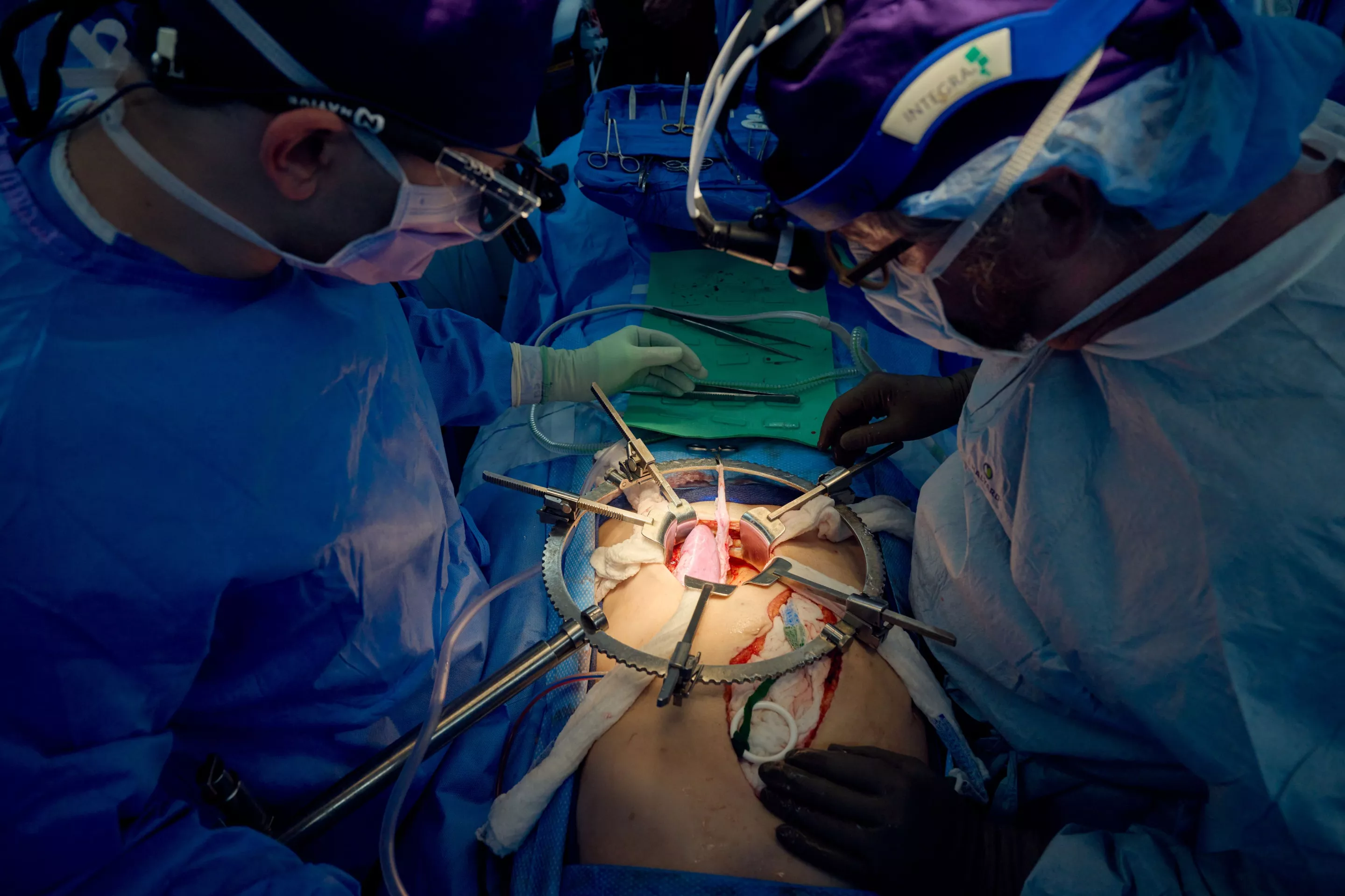 The pig kidney transplant operation