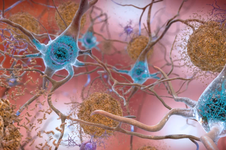 Tau tangles (blue) can build up inside neurons, and are implicated in the formation of Alzheimer's