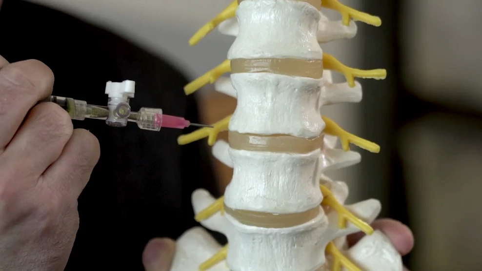 The procedure takes only five to 10 minutes, after an initial discectomy
