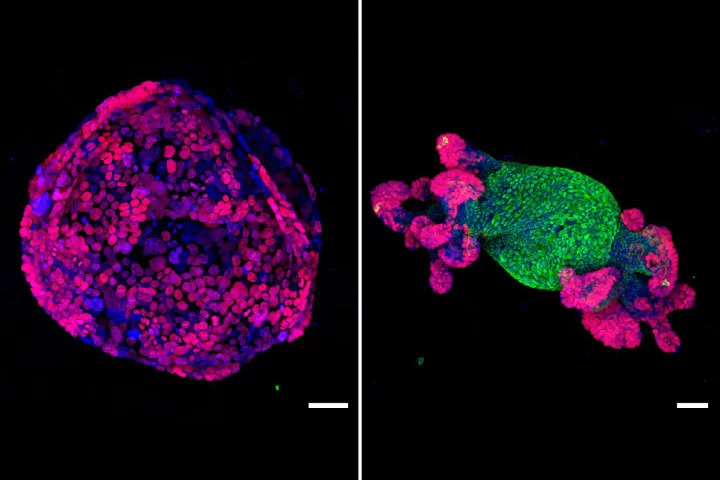 A cancerous intestinal growth (left) was restored to normal function (right) after researchers reactivated a key gene