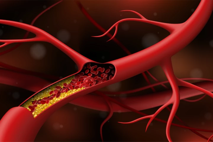 Scientists have demonstrated a new technique to take out arterial plaque, using low-power lasers and ultrasound to break it apart with tiny bubbles