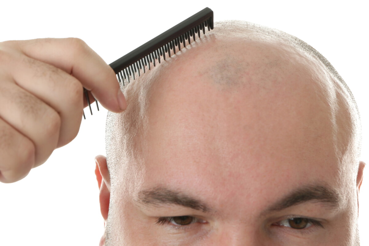 Hair-regrowth molecule could bypass stem cell treatments for baldness