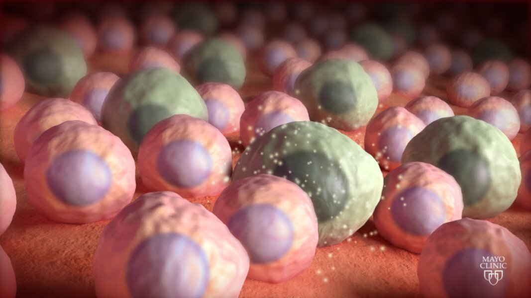 Clearing out brain's "zombie cells" offers new approach against dementia