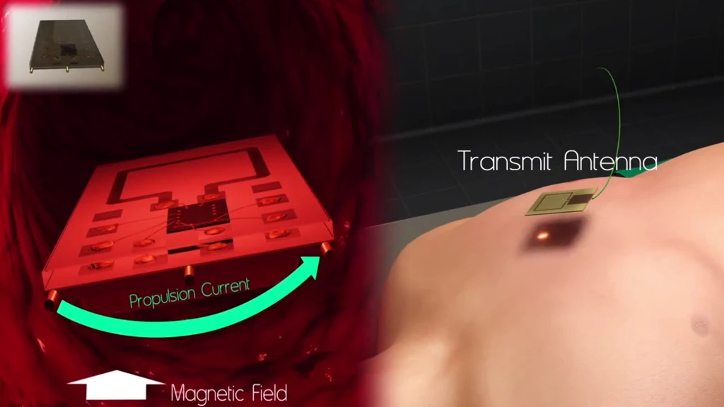 The implant developed at Stanford University would be wirelessly powered by a radio transmitter outside the body