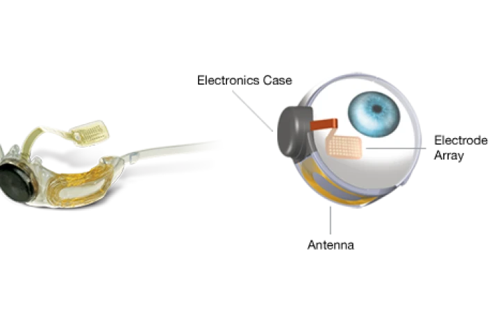 Argus II consists of a tiny video camera mounted in glasses that is wirelessly linked to a receiver and microelectrode array implanted onto the patient's retina