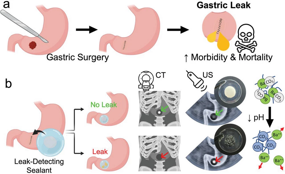 a) Gastric surgery puts a patient at risk of postoperative complications caused by leaking tissue reconnections, releasing gastric fluids into the abdominal cavity. b) The dual-modality leak-detecting patch allows early leak detection via computed tomography (CT) and ultrasound (US) based on contrast changes due to the decomposition of barium (or lanthanum) carbonate and the formation of carbon dioxide (CO2) bubbles entrapped in the hydrogel matrix.