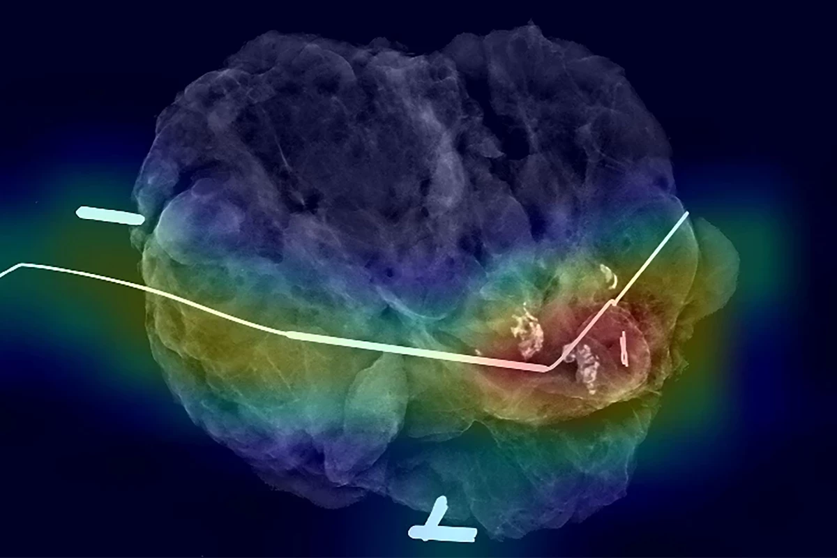 Researchers have taught an AI model to predict whether surgeons have removed all cancerous tissue during breast cancer surgery