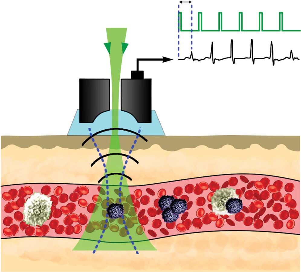 The Cytophone's laser pulses (in green) moving through the ultrasound transducer (black) and into the blood vessel, identifying a melanoma circulating tumor cell