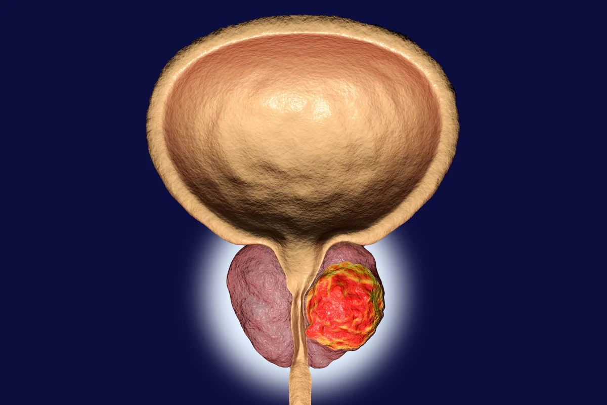 An extract of sandalwood oil has proven an effective prostate cancer treatment in mice