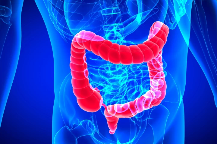 Diiverticulitis risk can be greatly reduced even if you're genetically more likely to develop it, new study finds