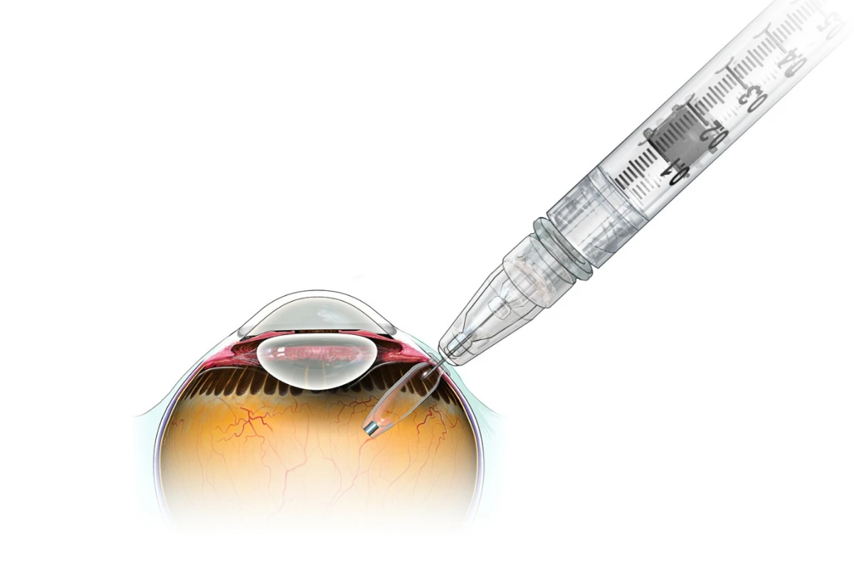 The Port Delivery System incorporates an implanted drug reservoir, which is externally refilled
