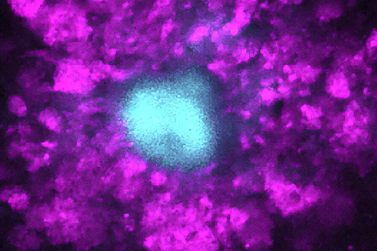 A microscope image of amyloid plaques (blue) surrounded by swelling in axons (purple)