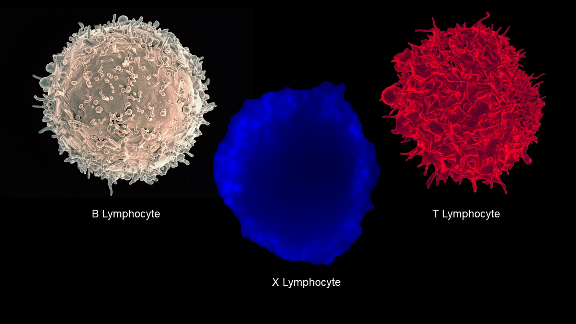 Colorized scanning electron micrographs of a B and T immune cells shown with a fluorescent microscopy image of the previously unseen new "hybrid" cell, thought to play a major role in the onset of type 1 diabetes
