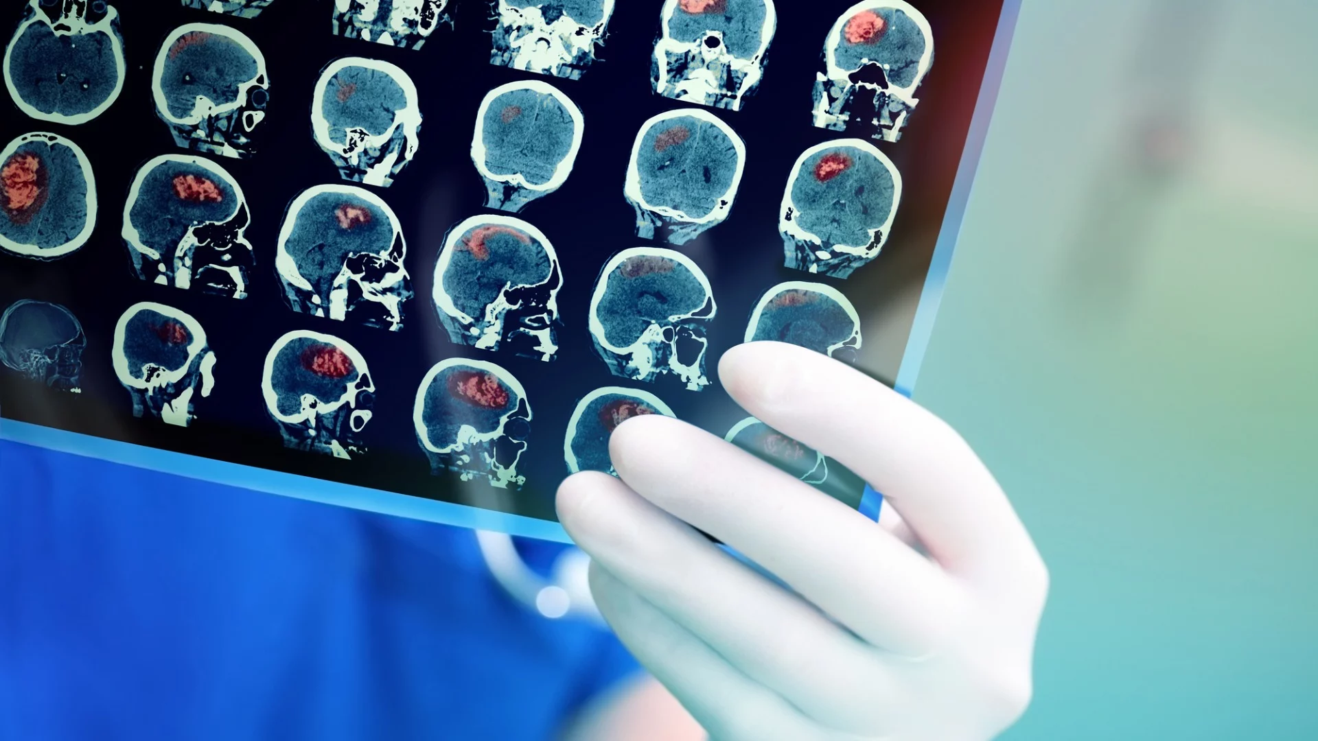 Researchers have discovered gadolinium, a chemical regularly given to patients for MRI scans, is accumulating in the eyes and may provide increase understanding of strokes