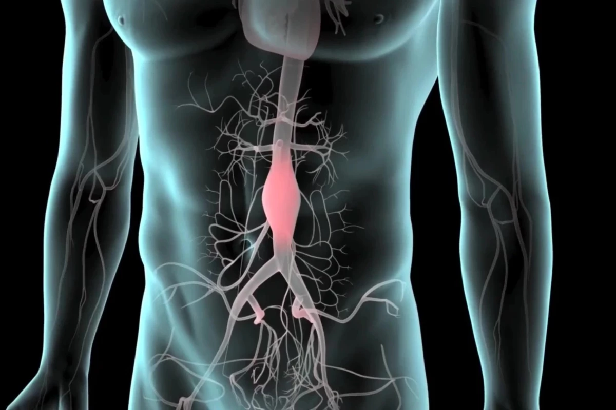 Scientists find that elevated TMAO levels significantly increase the risk of developing a serious abdominal aortic aneurysm
