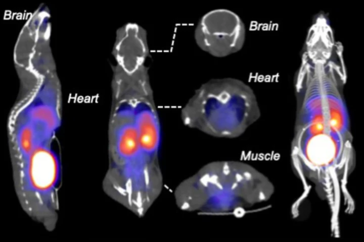 Radioactive fructose illuminated cancer cells and brain and heart inflammation on a PET scan