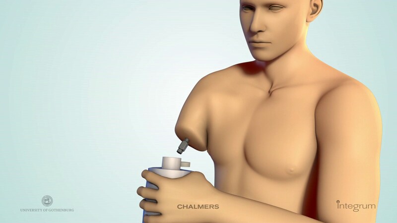 The titanium implant and removable prosthesis