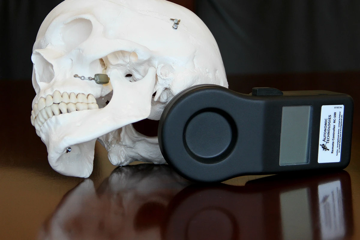 The ATI Neurostimulator (on skull, at left) and its handheld remote control (Photo: The Ohio State University)