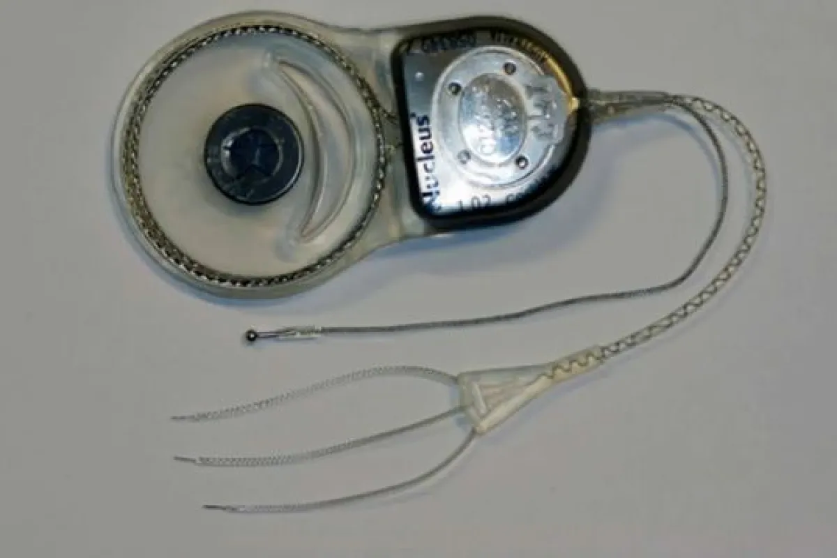 The vertigo-alleviating cochlear implant
