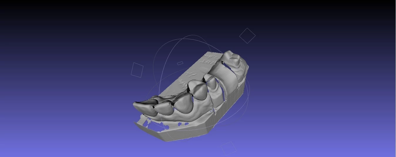 Dentures modeled using the David-laserscanner system
