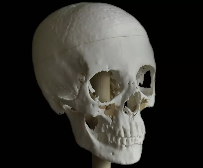 The skull was 3D-printed from a CT scan