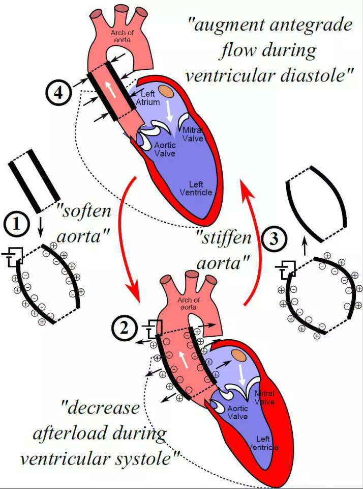 A diagram showing how the new artificial aorta works